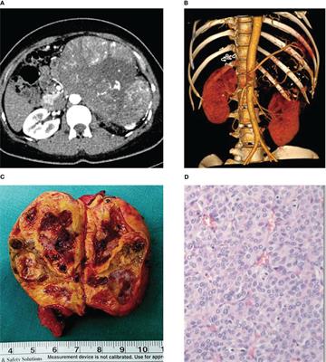 Long-term partial response in a patient with liver metastasis of primary adrenocortical carcinoma with adjuvant mitotane plus transcatheter arterial chemoembolization and microwave ablation: a case report